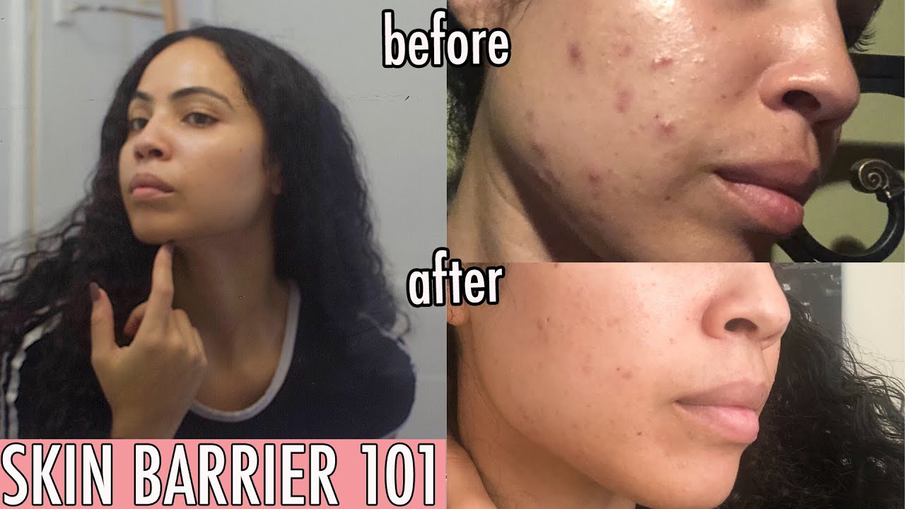 Repairing The Skin Barrier to Get Rid of Acne: Before and After Results