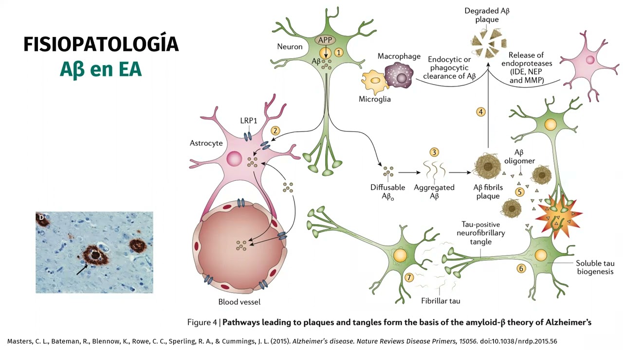 Biomarcadores en Enfermedad de Alzheimer