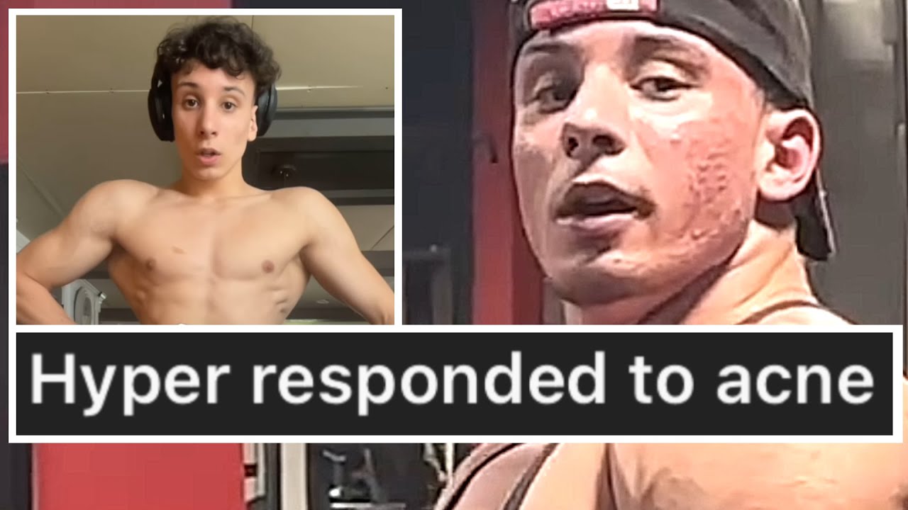 Steroid Face || Hyper Responded To Acne