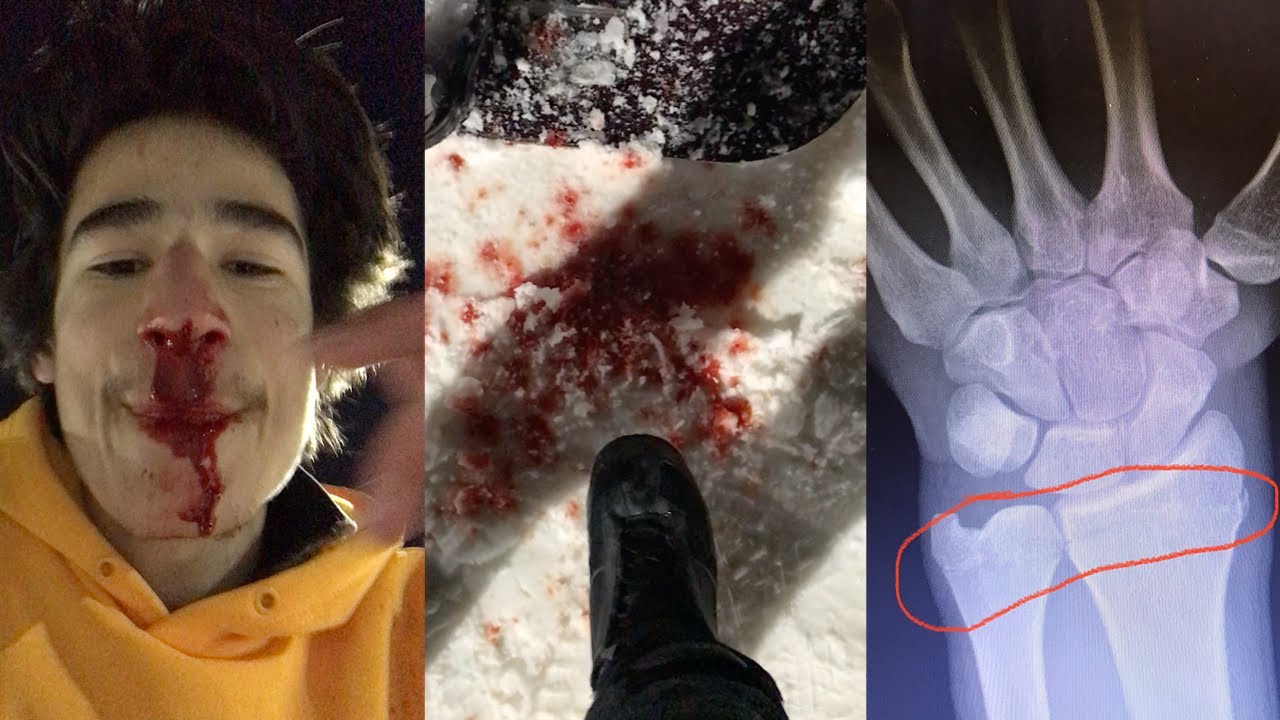SCARY SNOWBOARD ACCIDENT!