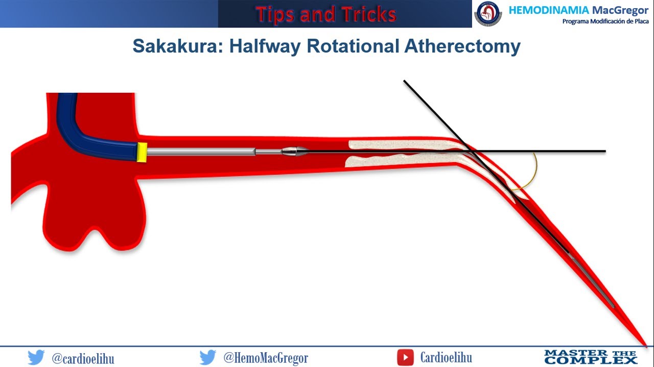 Halfway Rotational Atherectomy
