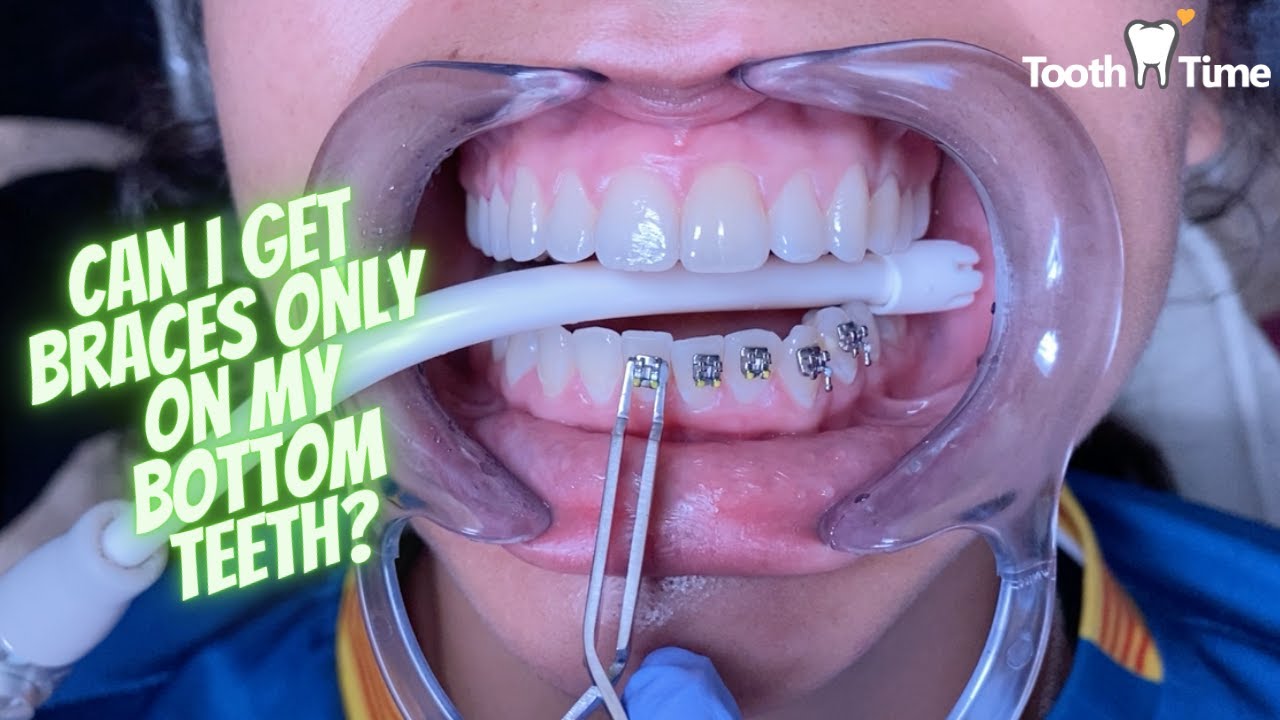 Can I only get braces on my bottom teeth? - Braces On - Tooth Time Family Dentistry New Braunfels TX