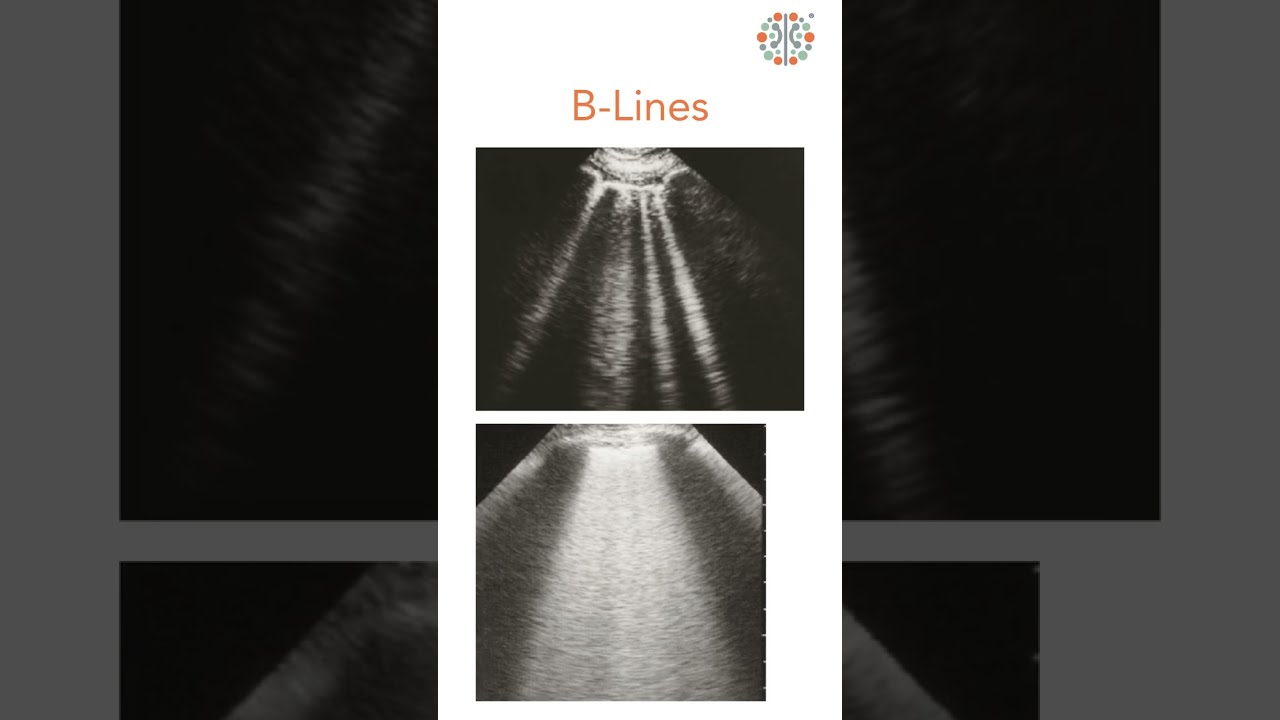 POCUS Bytes Ep. 9 - Lung Ultrasound POCUS Byte