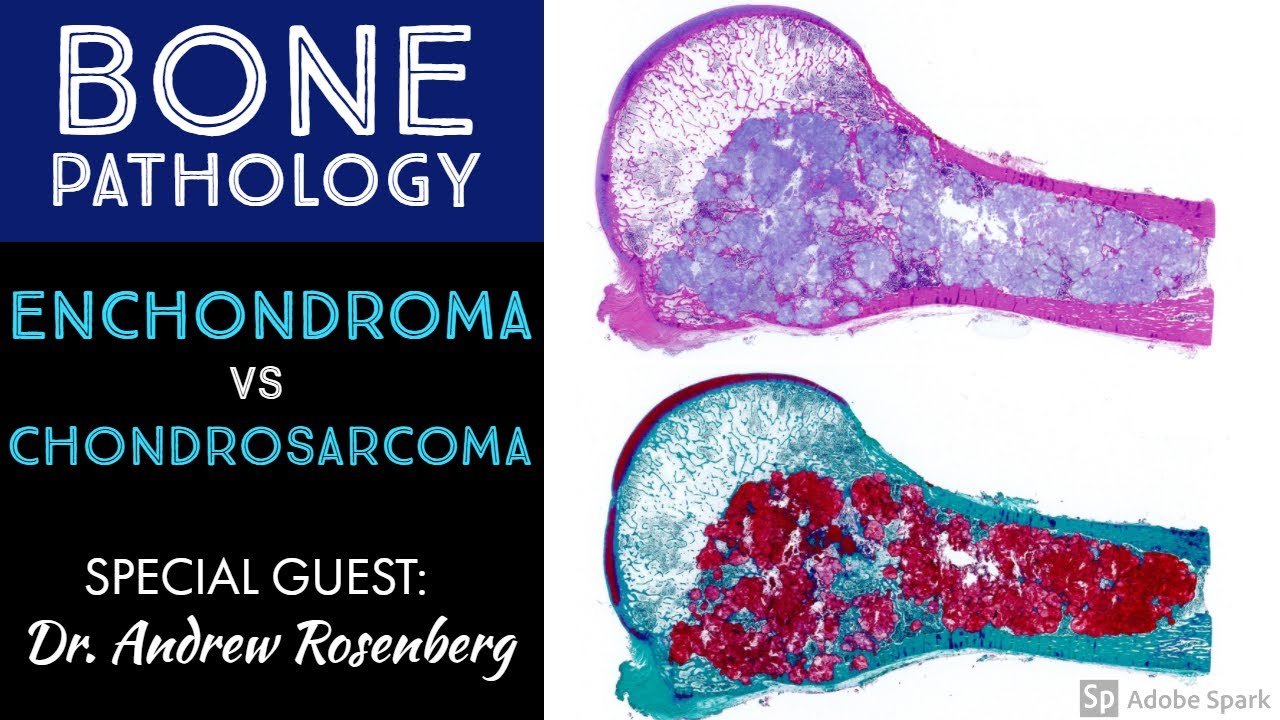 Chondrosarcoma vs Enchondroma: Bone Pathology with Dr. Andrew Rosenberg