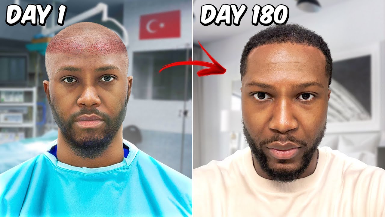 I Got a Hair Transplant in Turkey 😱| Here’s the 6-Month | Before & After | Was it worth it?
