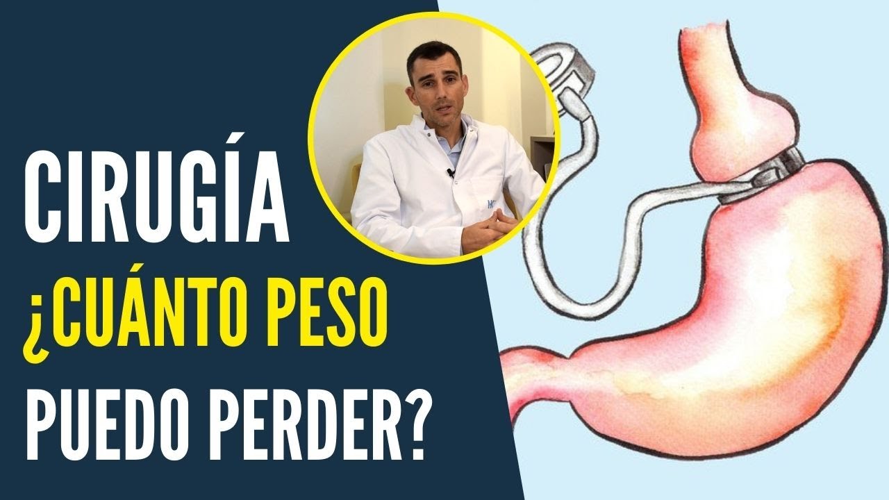 Cuánto PESO puedo perder con una CIRUGÍA - Doctor Álvaro Bueno Delgado