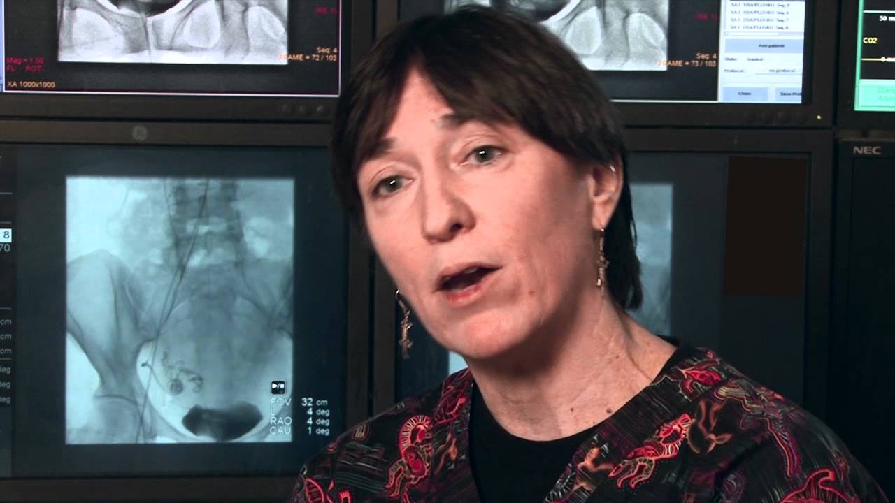 What is the recovery process for uterine fibroid embolization (UFE)?