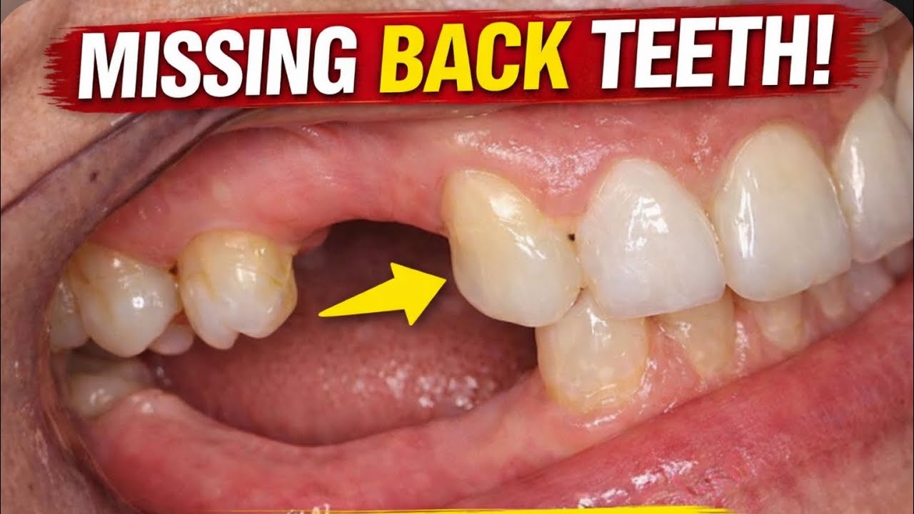 5 Best Ways to Replace Missing Back Teeth | Dr.Dentique-hub 
