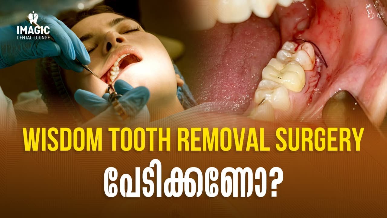 Wisdom tooth surgery അറിയേണ്ടതെല്ലാം! #wisdomtooth #wisdomtoothremoval
