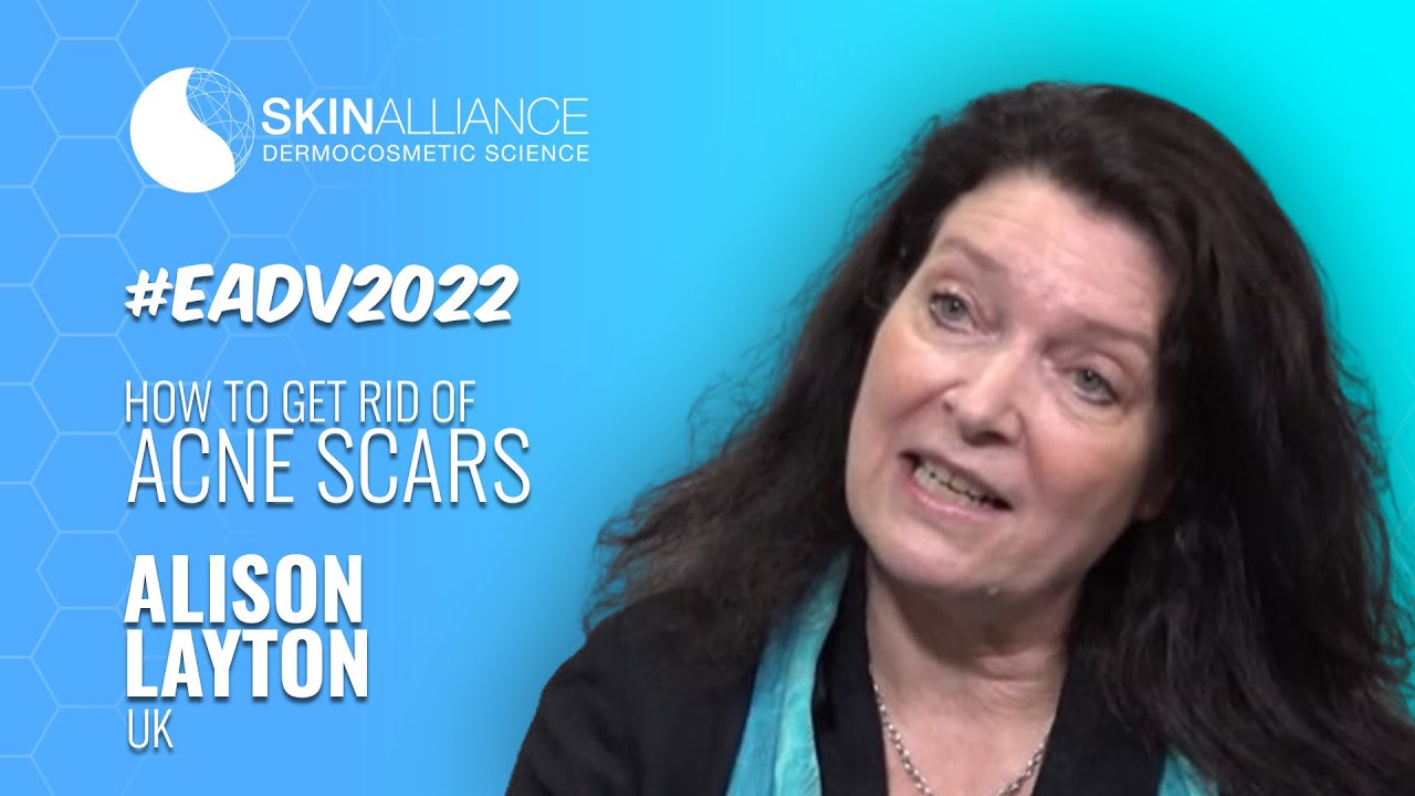 How to get rid of Acne Scars | Acne Scars Treatment | Alison LAYTON | Skinalliance LDB