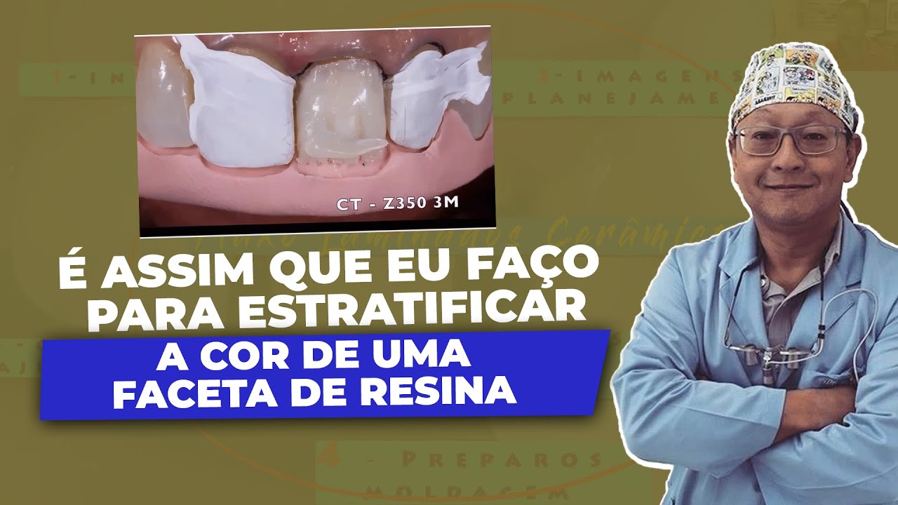 &Eacute; assim que eu fa&ccedil;o para estratificar a cor de uma Faceta de Resina