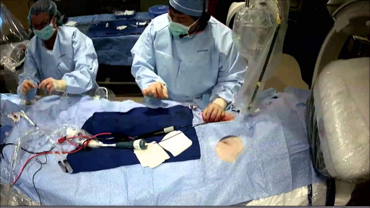 Atrial Fib Ablation Live Discussion case by Dr. Wilber Su using Second Generation Cryoballoon