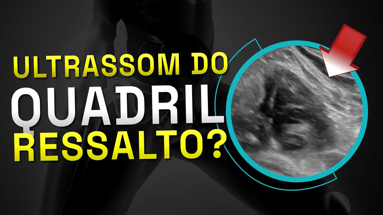Ultrassom do quadril! Ressalto? MSKD Casos 42
