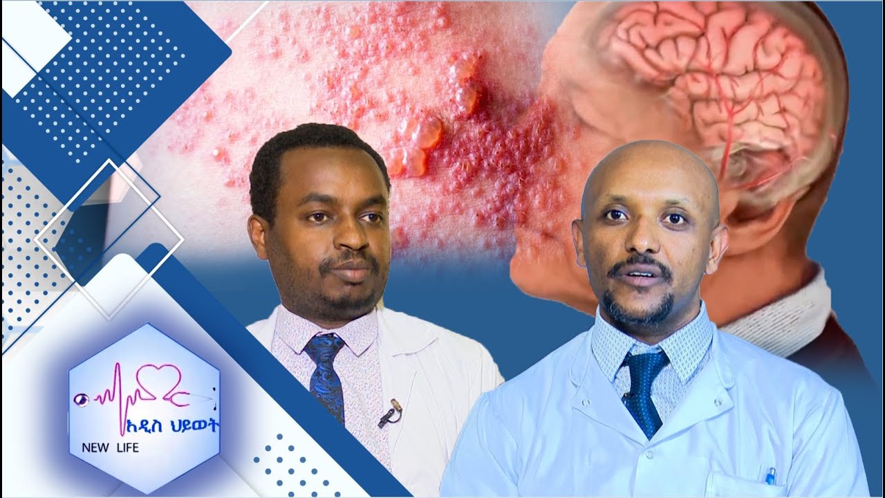 አልዛይመር በዘር ሊተላለፍ ይችላል / 