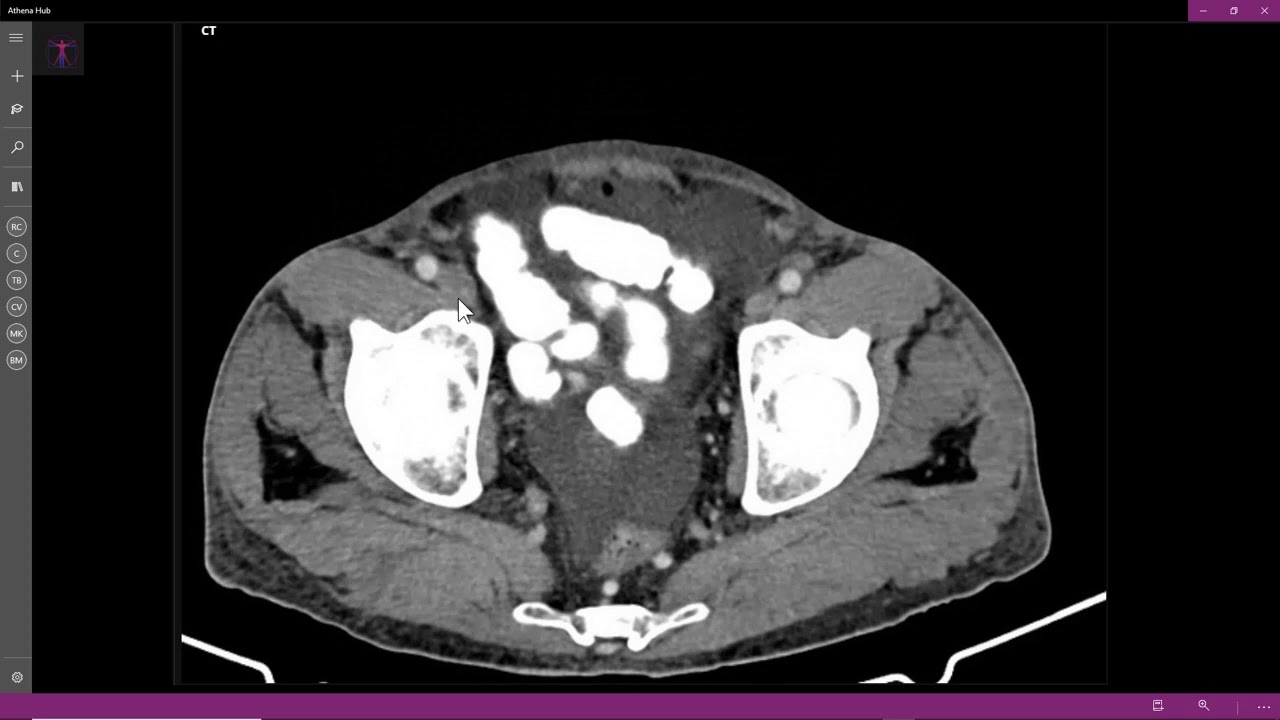 Carcinoma hepatocelular