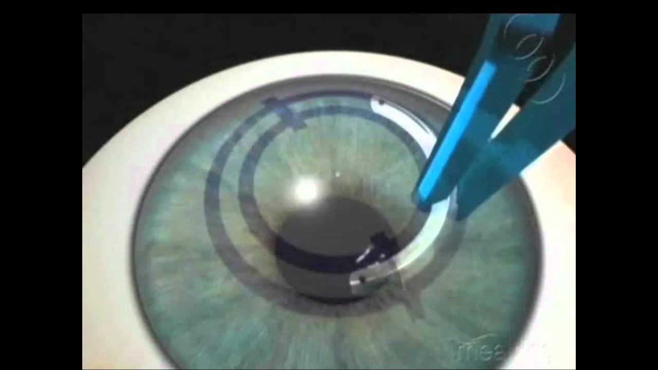 Cirugia de segmentos intracorneales