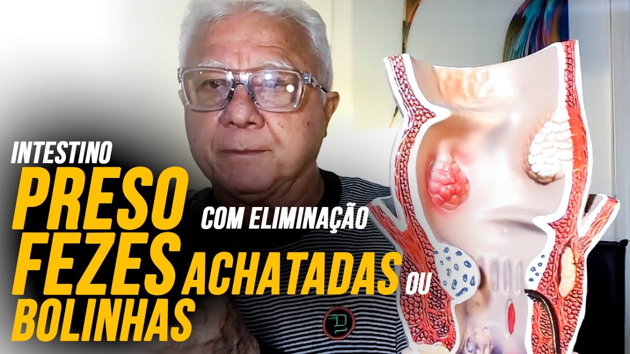 Fezes achatadas ou bolinhas ao evacuar saibam a causa ao vivo forma interativa c/Dr.Paulo Branco: