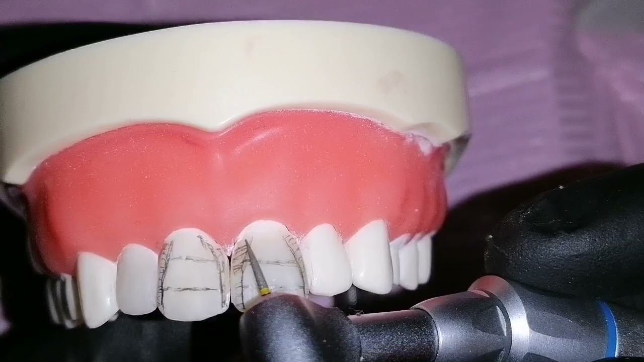 finishing and polishing of anterior composite