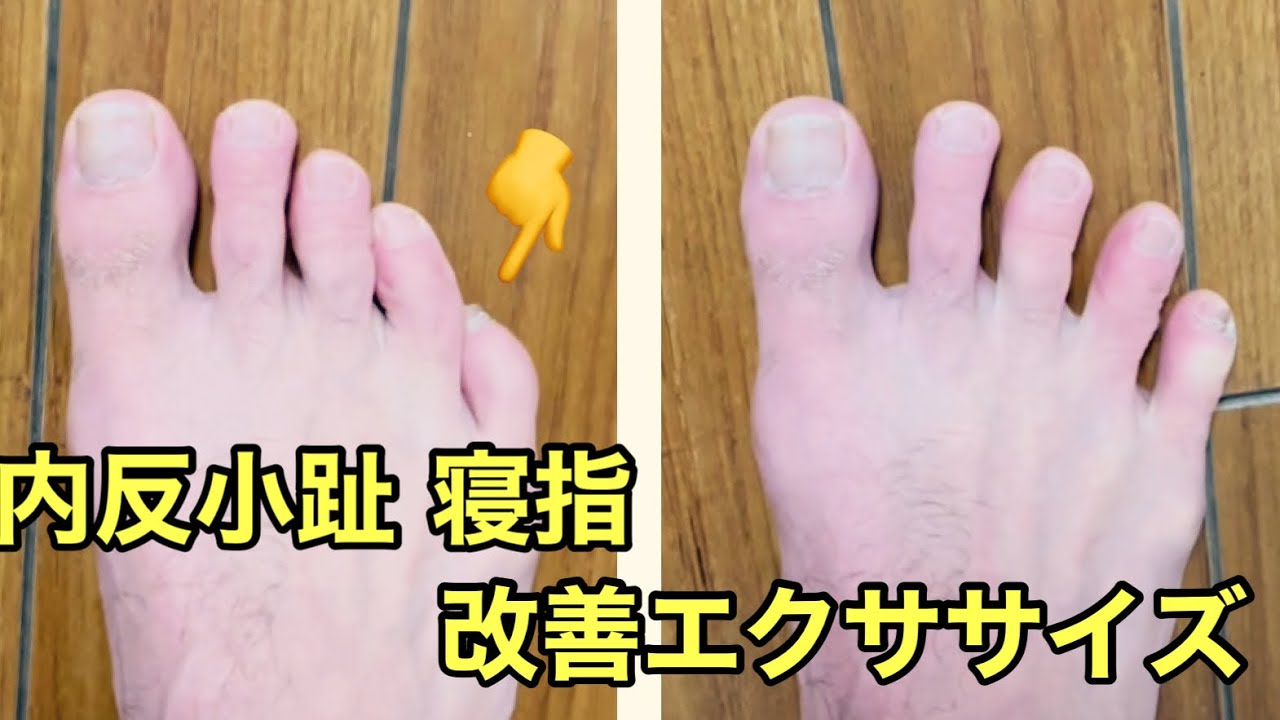 内反小趾 寝指　改善エクササイズ