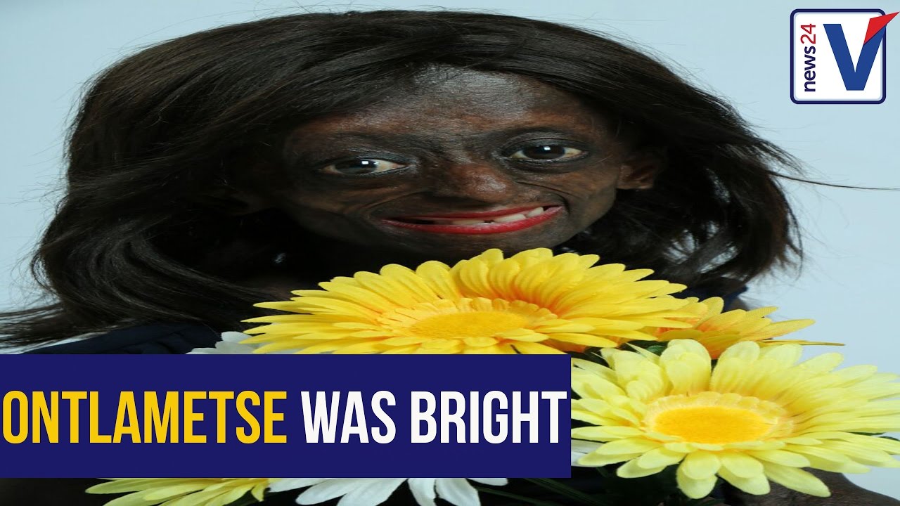 'Ontlametse Phalatse's progeria caused great suffering'-                 says Phalatse's aunt