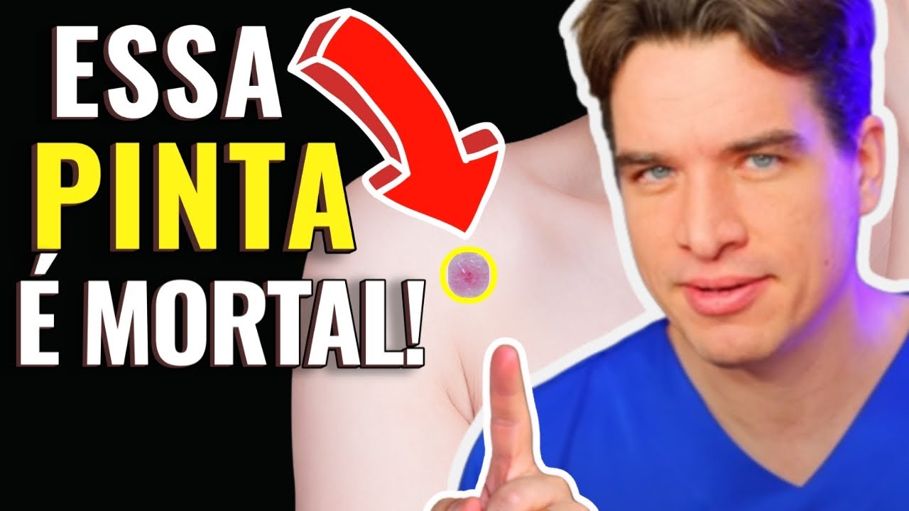 ALERTA DE CÂNCER! Se a sua PINTA se parece com ISTO, pode ser MORTAL