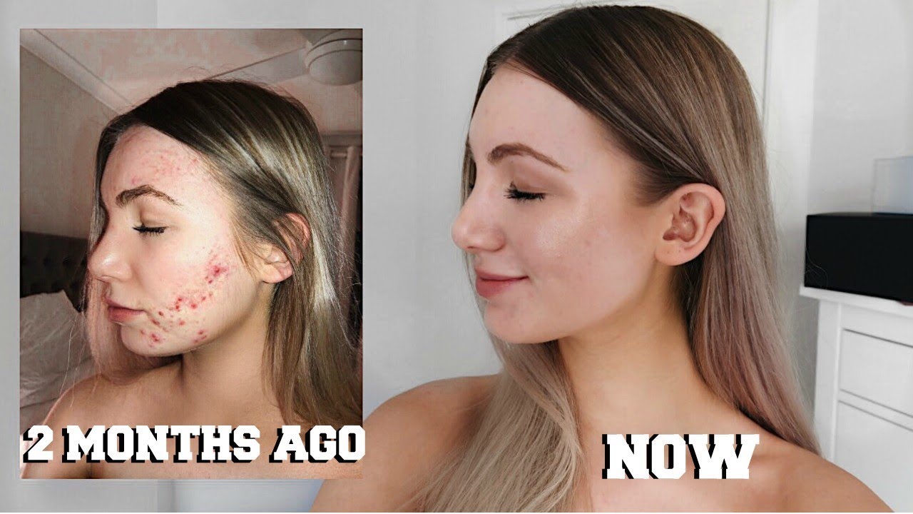 HOW I CLEARED MY SKIN (what I did + skincare routine)