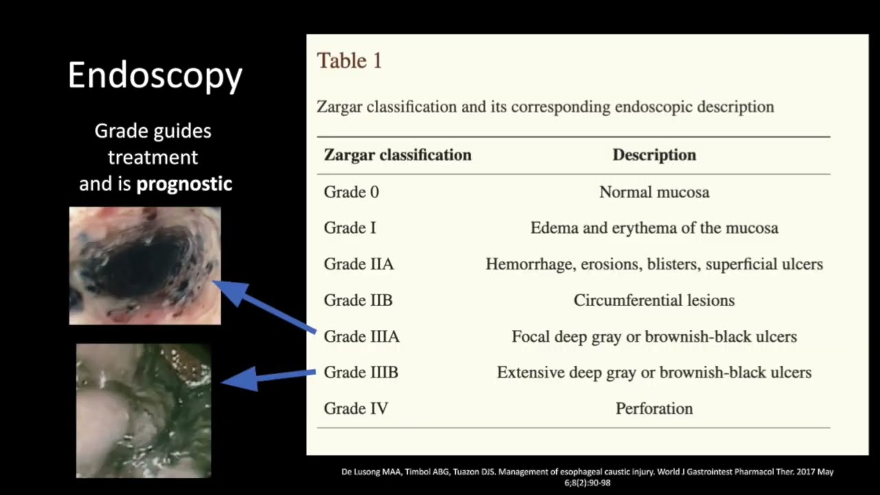 Caustic Ingestion: Dr Jennifer Hubbard, MD