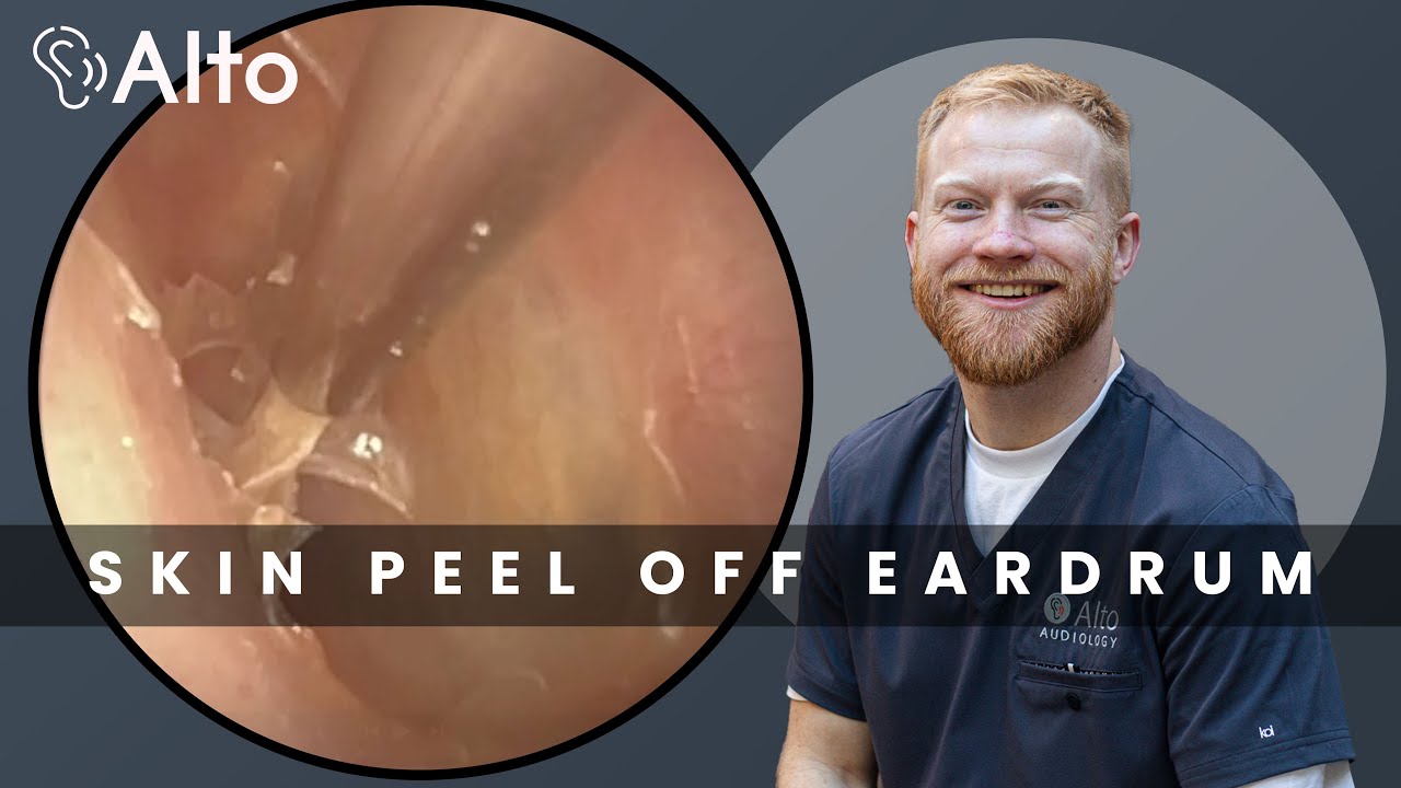 The Most DELICATE Ear Wax Removal We Do - Skin Peels Off the Eardrum EP033