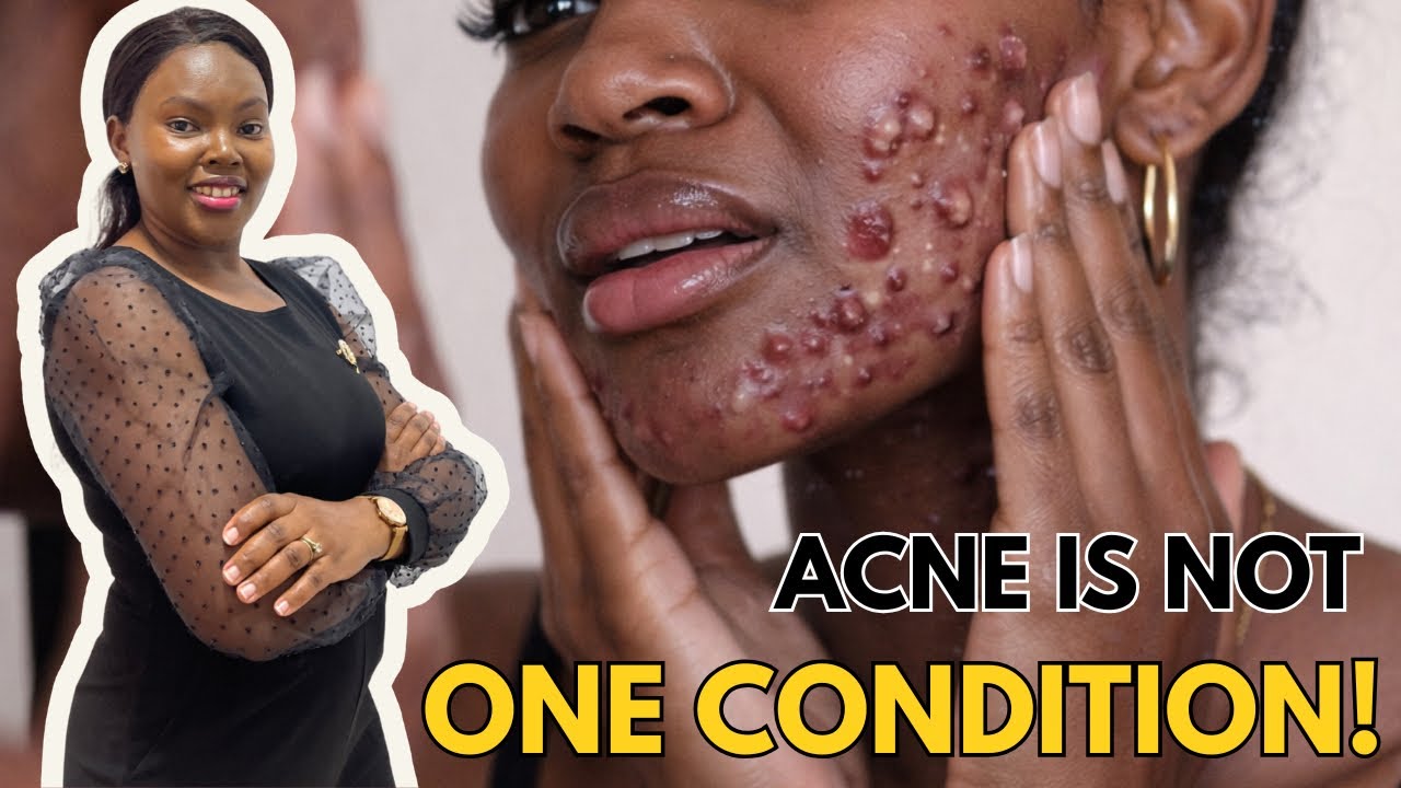 Why Acne Treatments Fail | Acne Is Not One Condition | ACNE SERIES | EPISODE 1