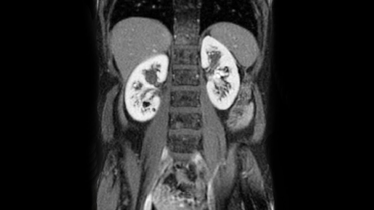 A Diabetic Mom Caught A Fever. This Is How Her Kidneys Shut Down.