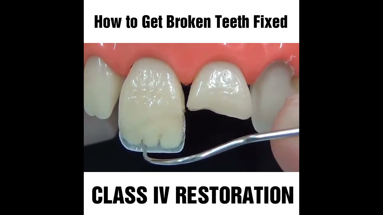 How to fix a chipped, cracked or broken tooth MyDentCart | Cracked tooth repair | Broken Tooth