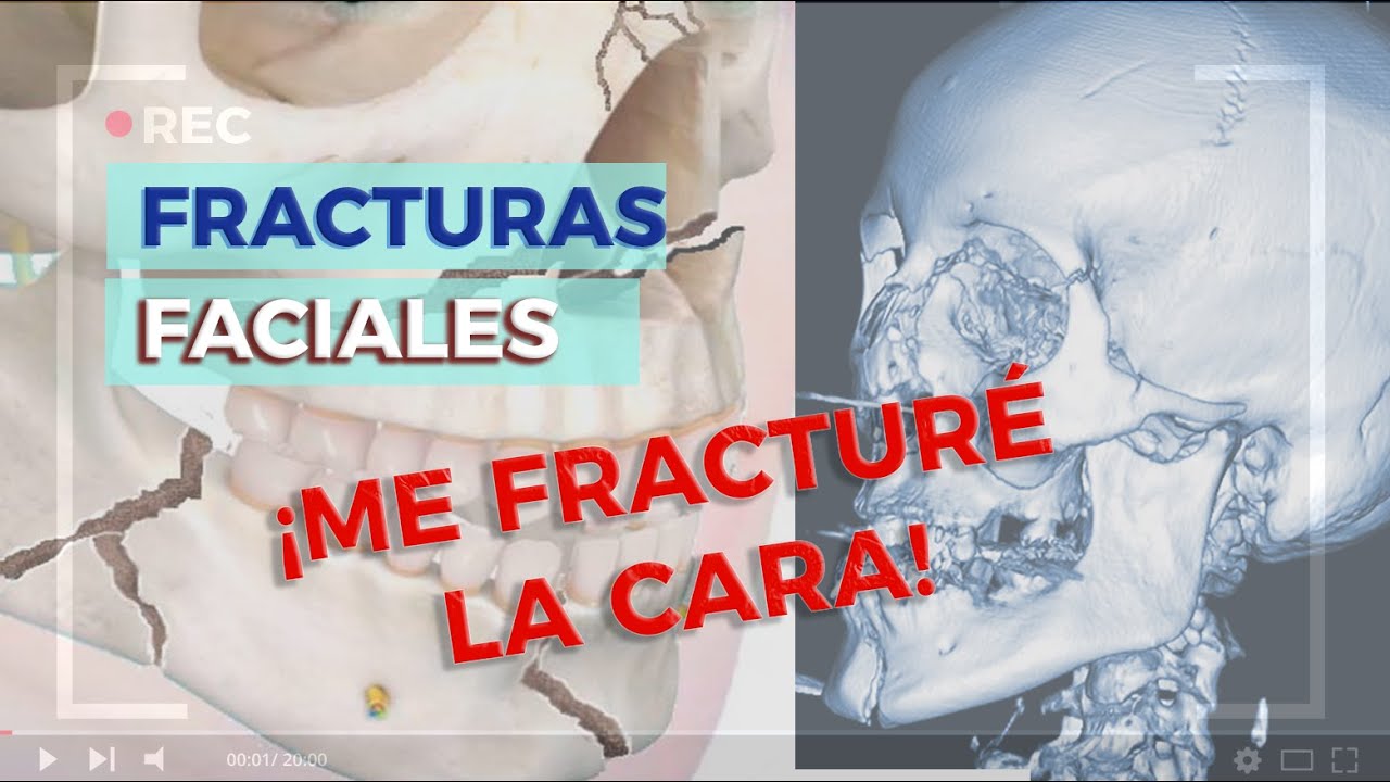 Fracturas Faciales