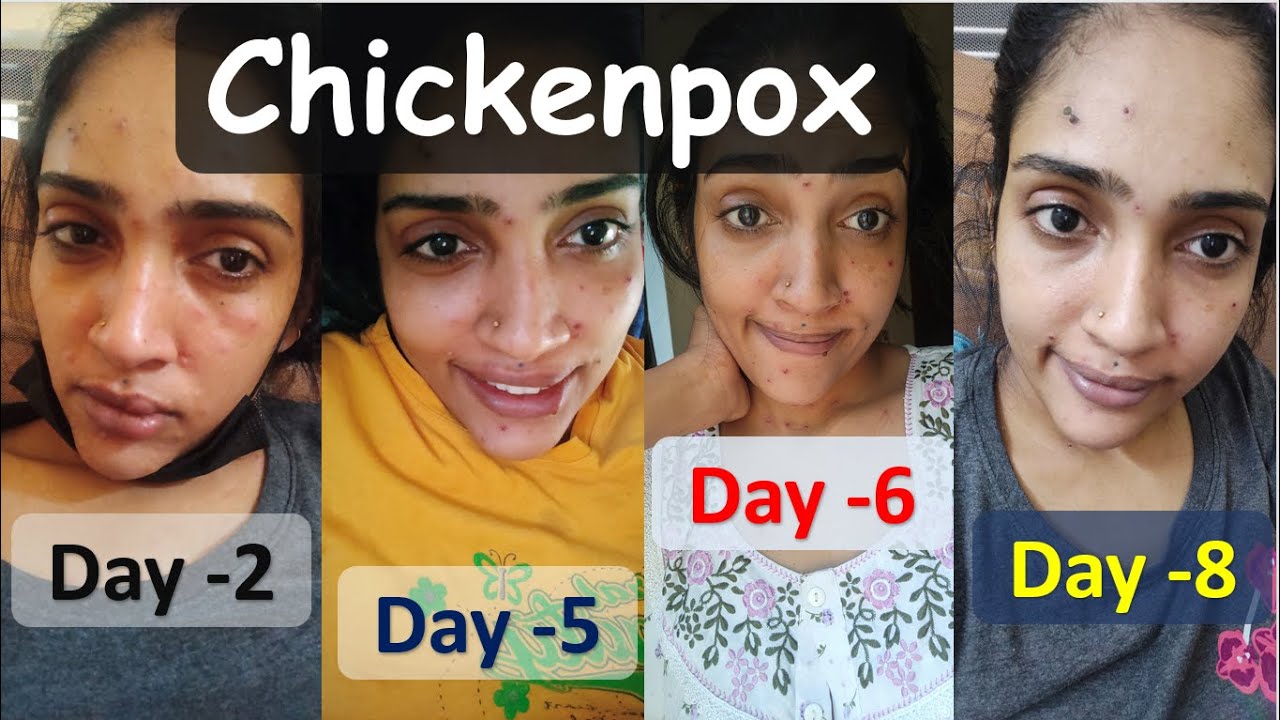 Chickenpox || Experience || Quarantine Life chickenpox