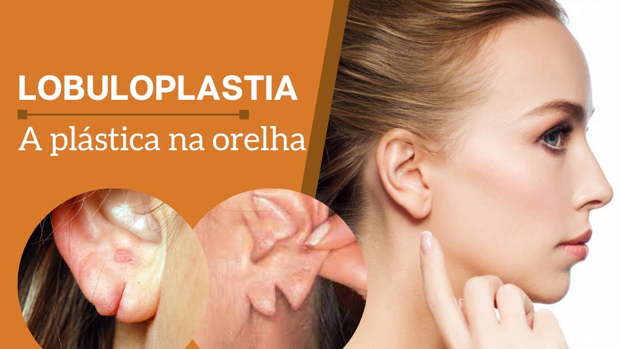 Lobuloplastia: Cirurgia para reconstruir orelha rasgada