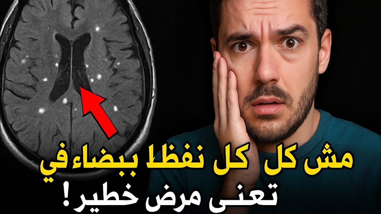 هلع بدون داعي بسبب النقاط البيضاء بأشعة الرنين المغناطيسي