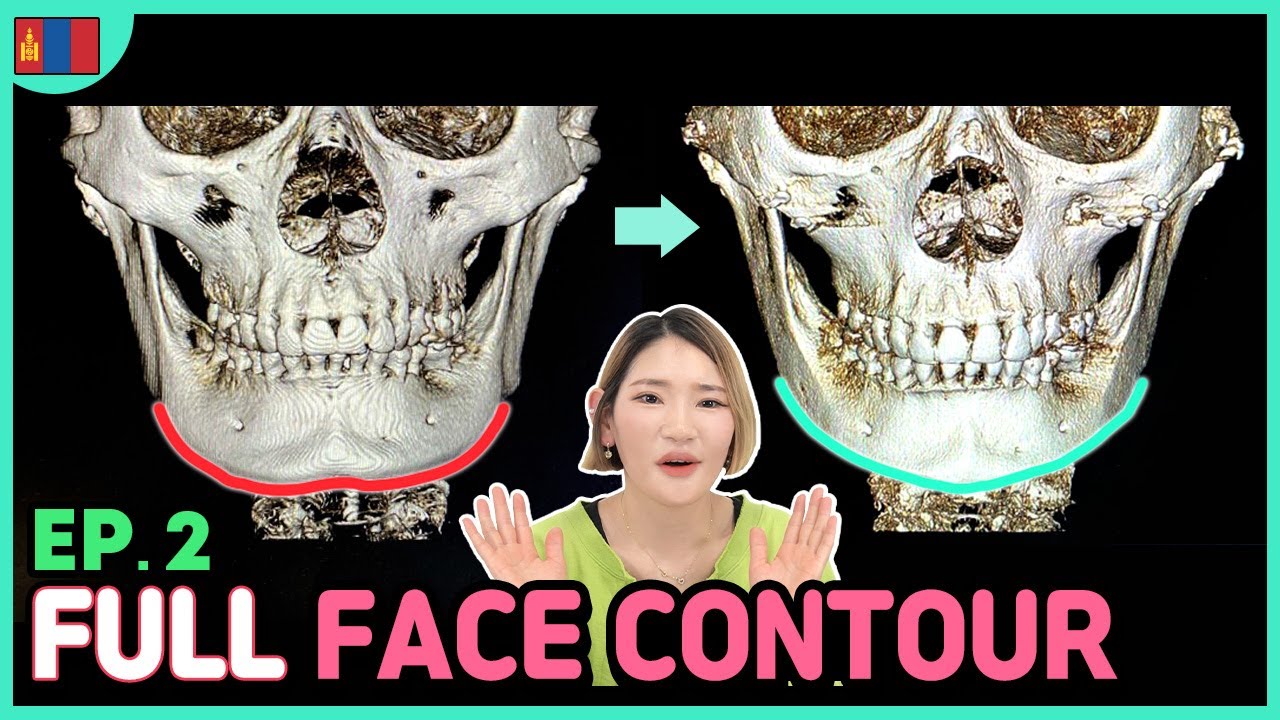[SUB] EP2. Facial contouring surgery in Korea Plastic Surgery Hospital | VLine Surgery vlog