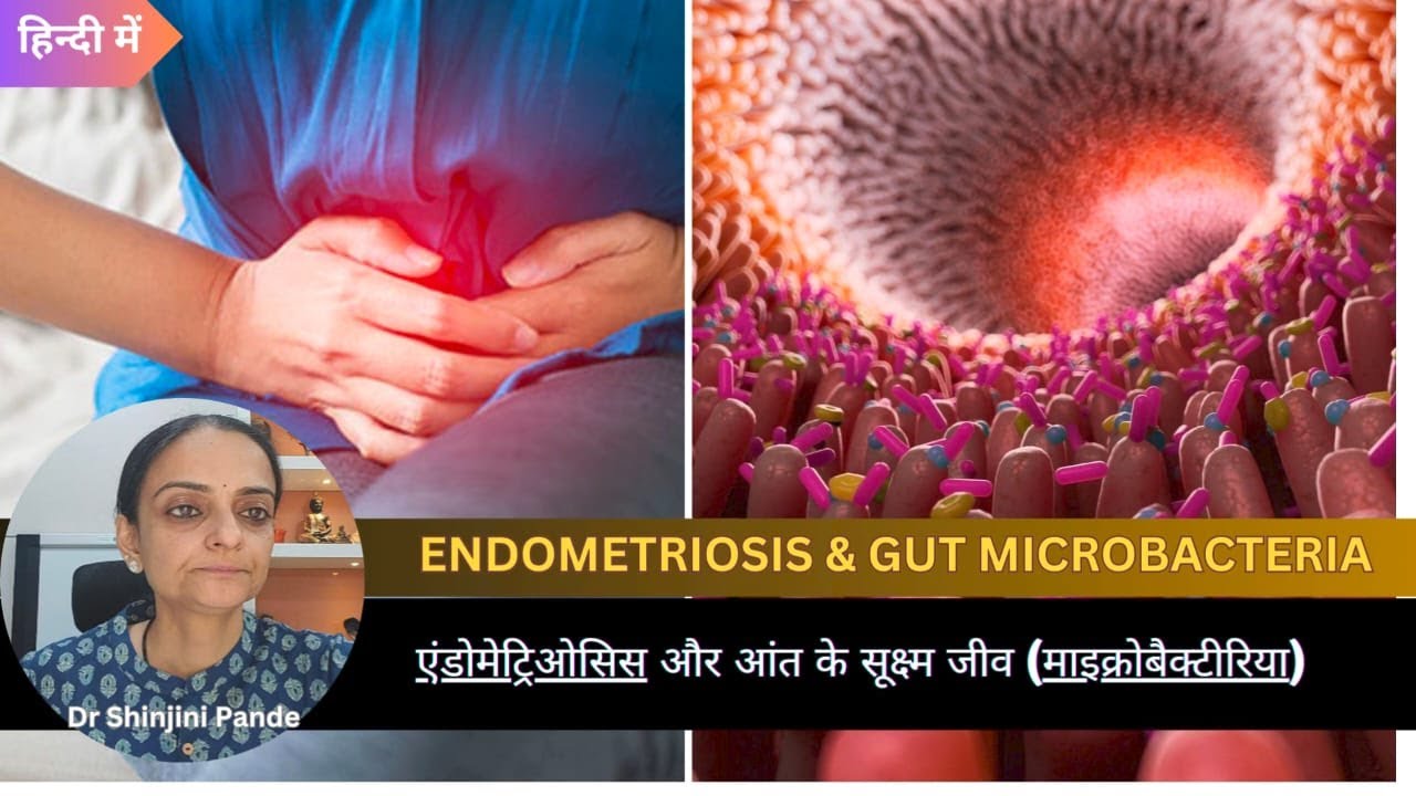 ENDOMETRIOSIS & GUT MICROBACTERIA /एंडोमेट्रिओसिस  और आंत के सूक्ष्म जीव (माइक्रोबैक्टीरिया)