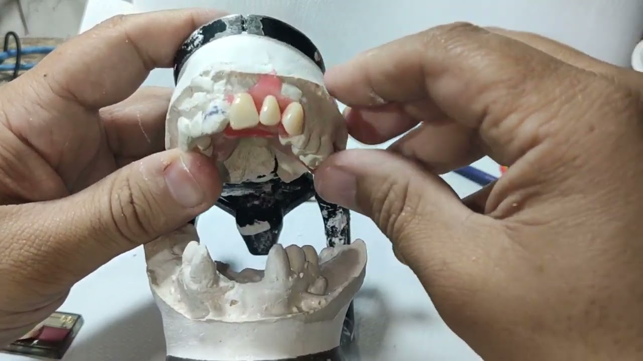Aula 03 - ( Montagem ) - curso rápido de prótese flexível.
