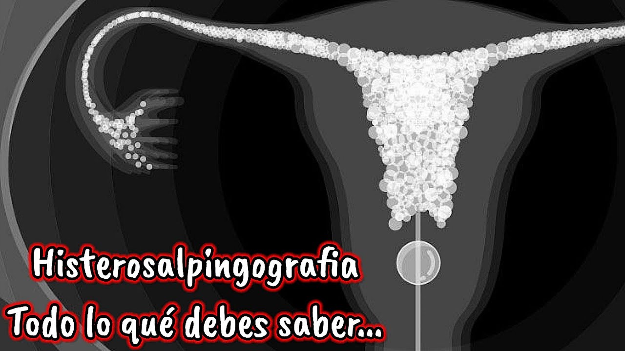 HISTEROSALPINGOGRAFÍA todo lo que debes saber...