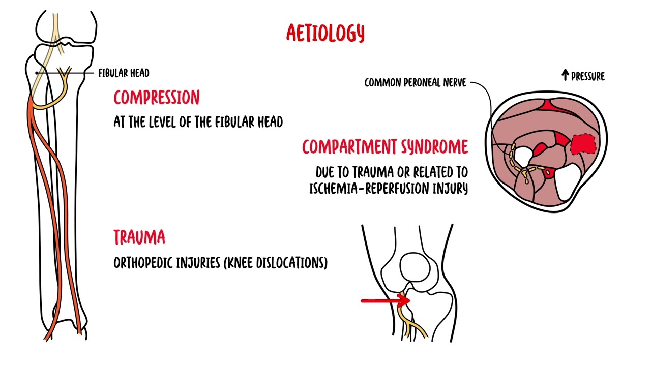 What is Foot Drop? Causes, Symptoms & Treatment Explained