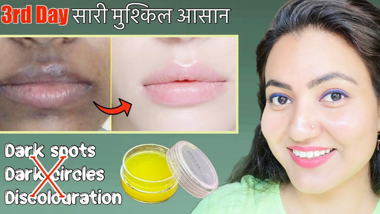 Skin Transformation Challenge (Day 3) : Remove Dark Spots, Dark Circles & Dark Patches Around Mouth