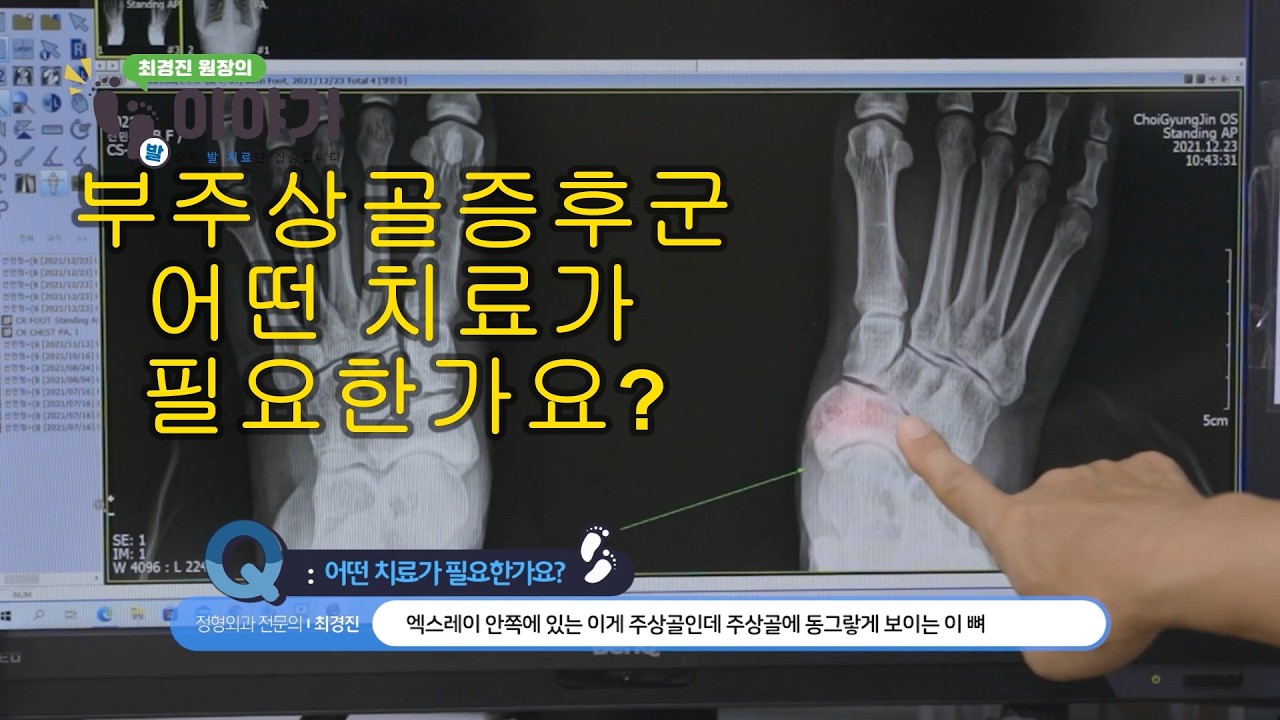 최경진정형외과 주상골부골증후군, 부주상골증후군 어떤 치료가 필요한가요?