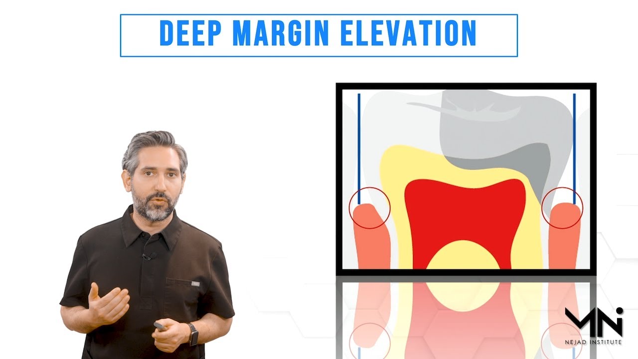 Deep Margin Elevation (DME) Technique and Kit Introduction