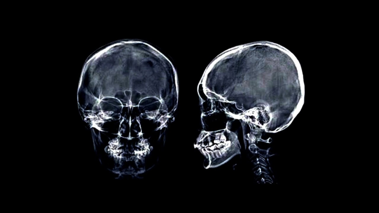 Lobotomy (Proof)