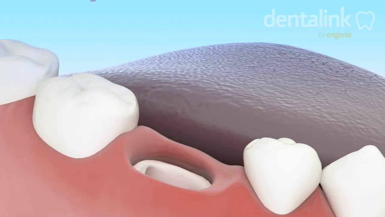 Exodoncia simple PASO A PASO - Video 3D