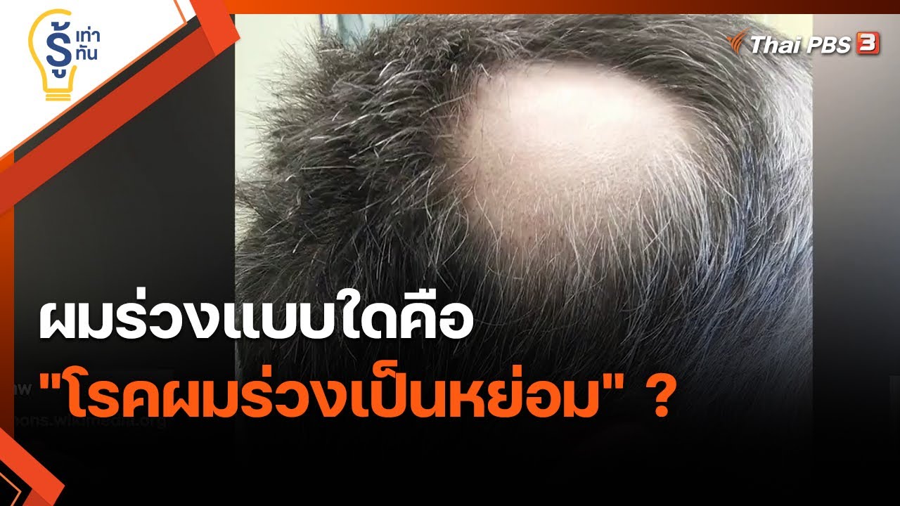ผมร่วงแบบใดคือ 
