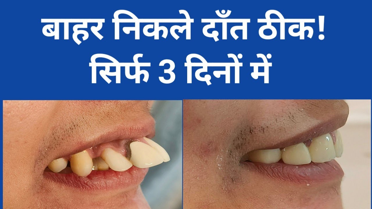 बाहर निकले दाँतों का smile design| सिर्फ 3 दिन में | Dr Priyanka Katewa // without braces // smile 