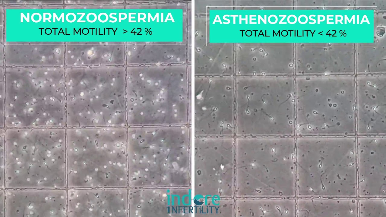 Asthenozoospermia | Sperms with Low Motility | Side by side comparison  Normal Vs Asthenozoospermia