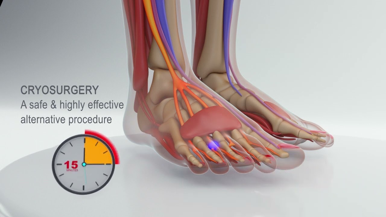 Heeling Morton's Neuroma with Minimally Invasive CryoSurgery Procedure