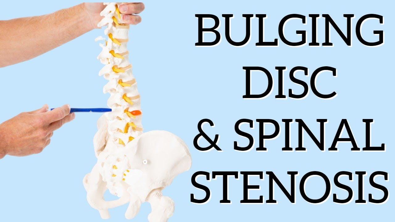 Best Exercise for Sciatica from Bulging Disc In Addition to Spinal Stenosis or Spondylolisthesis